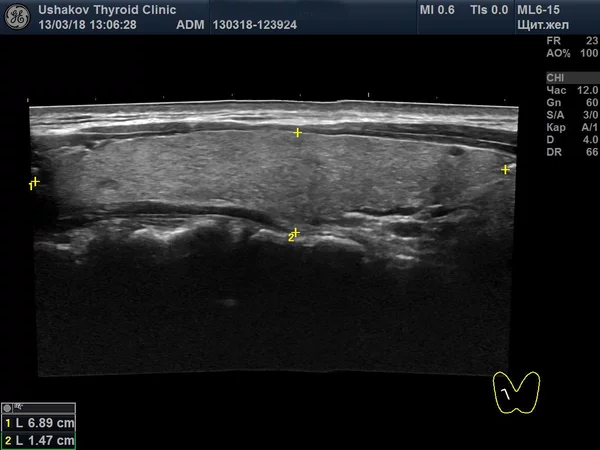 Восстановление доли щитовидной железы