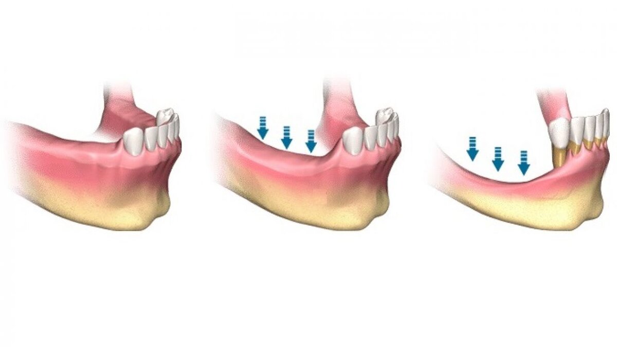На рисунке  значительное уменьшение костной ткани челюсти вследствие потери зубов.