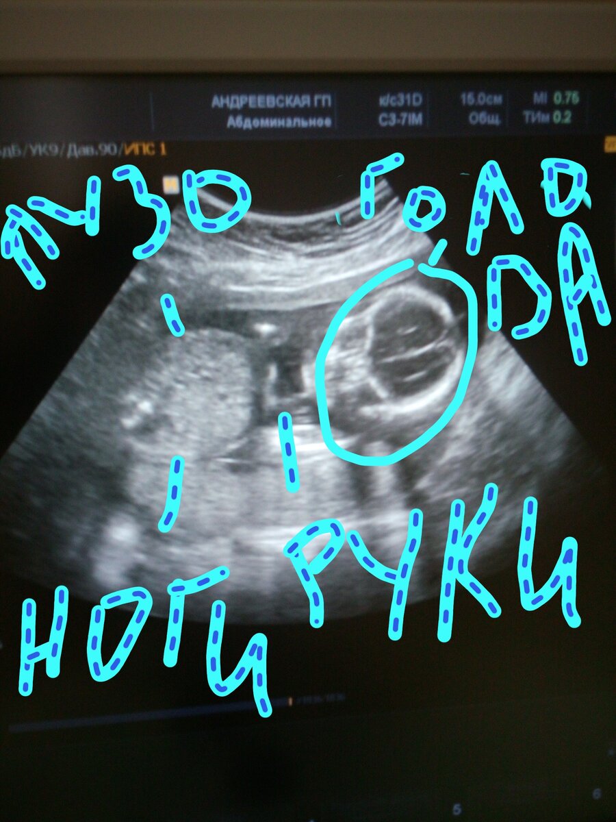 Фото с УЗИ