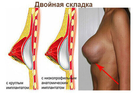 Двойная складка после маммопластики