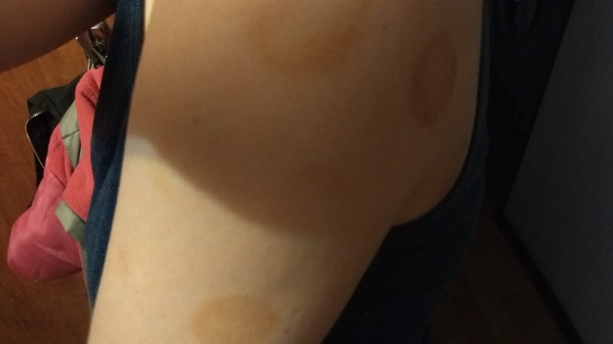 Следы от банок недельной давности, почти сошли