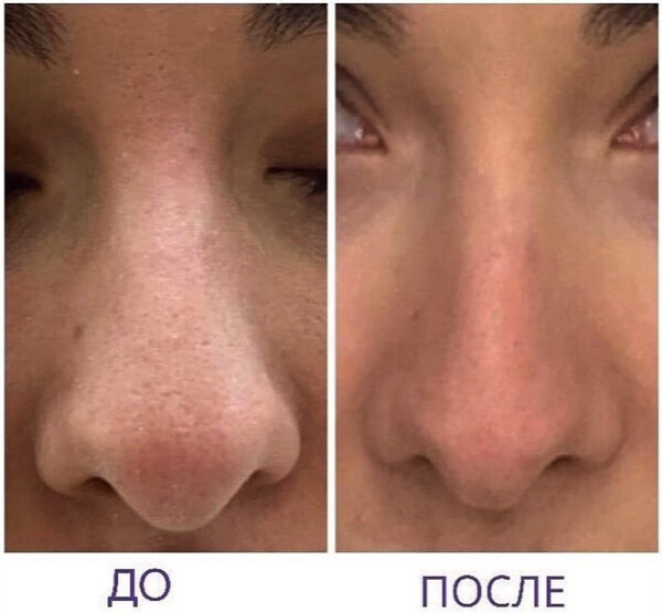 Пример безоперационной ринопластики Фото © Instagram / morozolga_beauty 