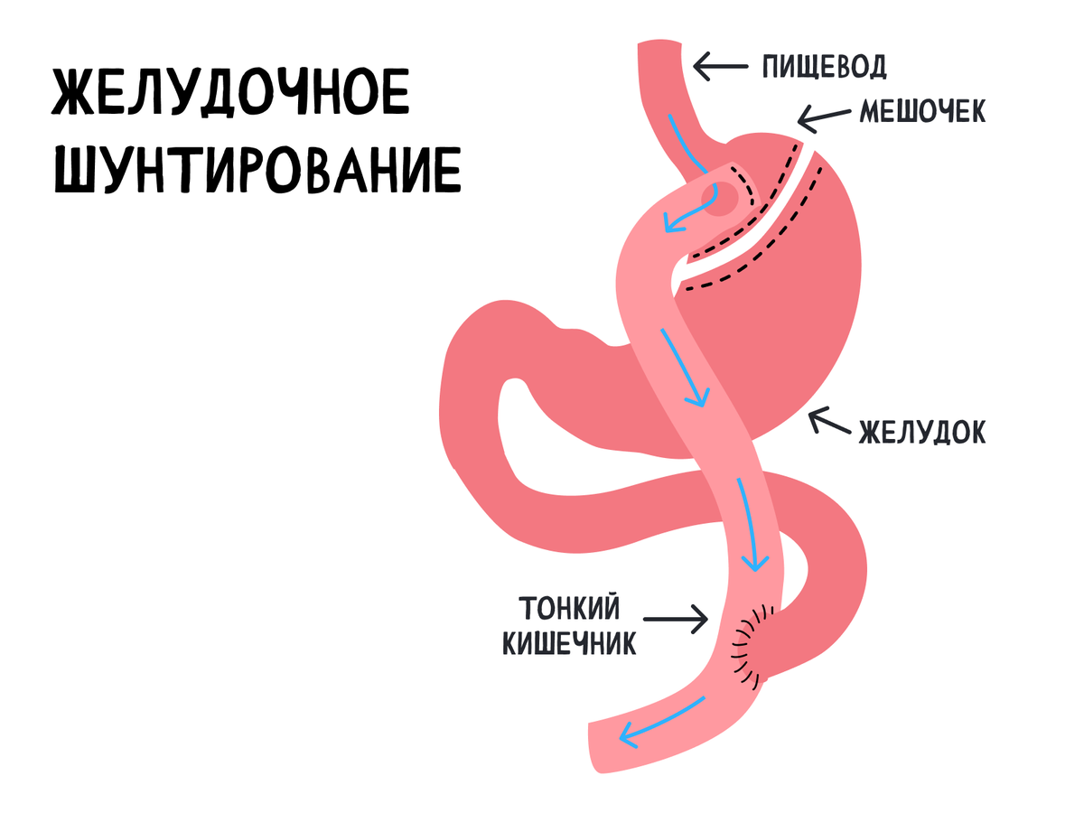 Выглядит так и подразумевает создание из небольшой верхней части желудка мешочка, который напрямую будет соединяться с тонкой кишкой.