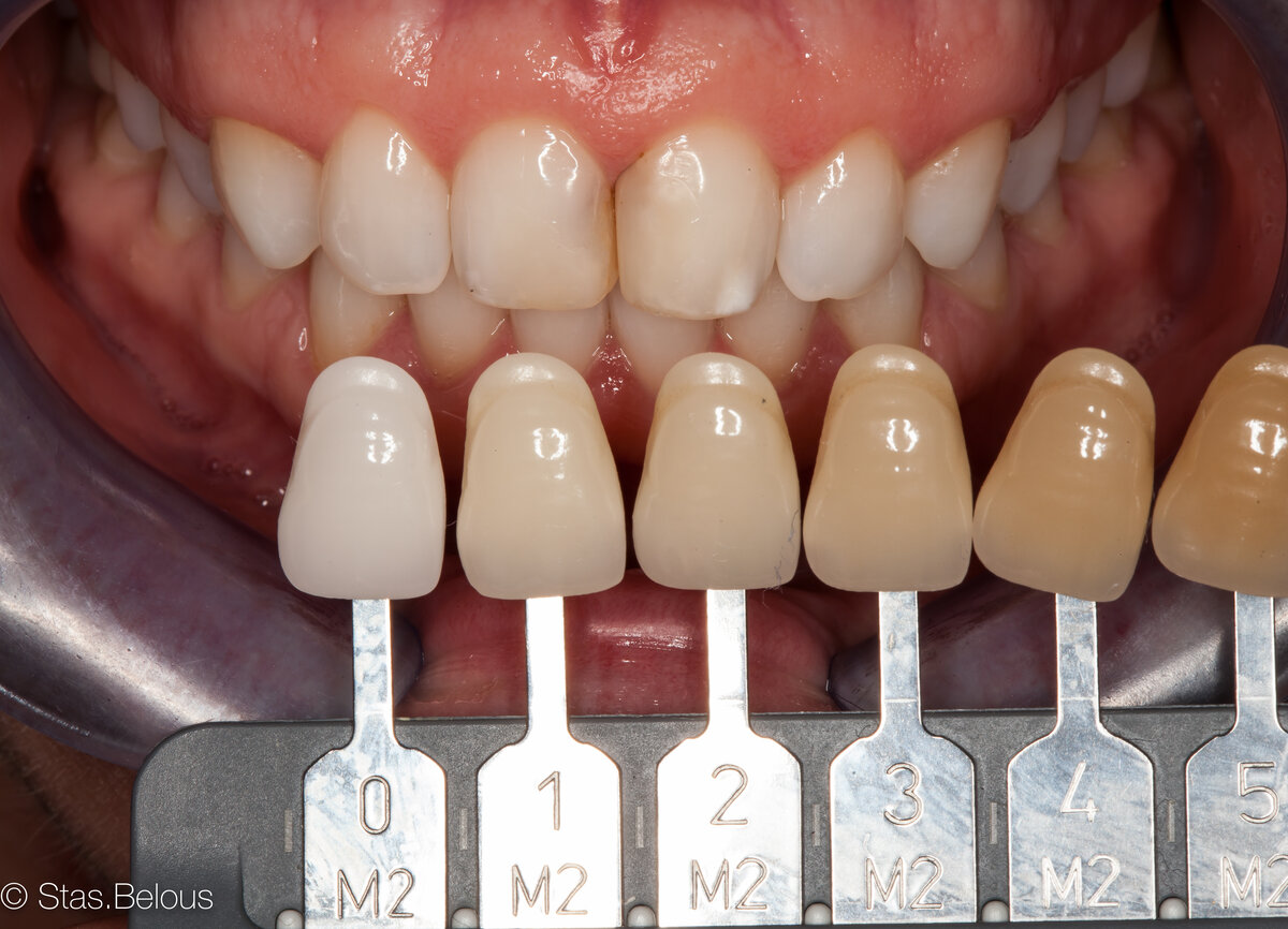 Зубы металлокерамика цвета фото