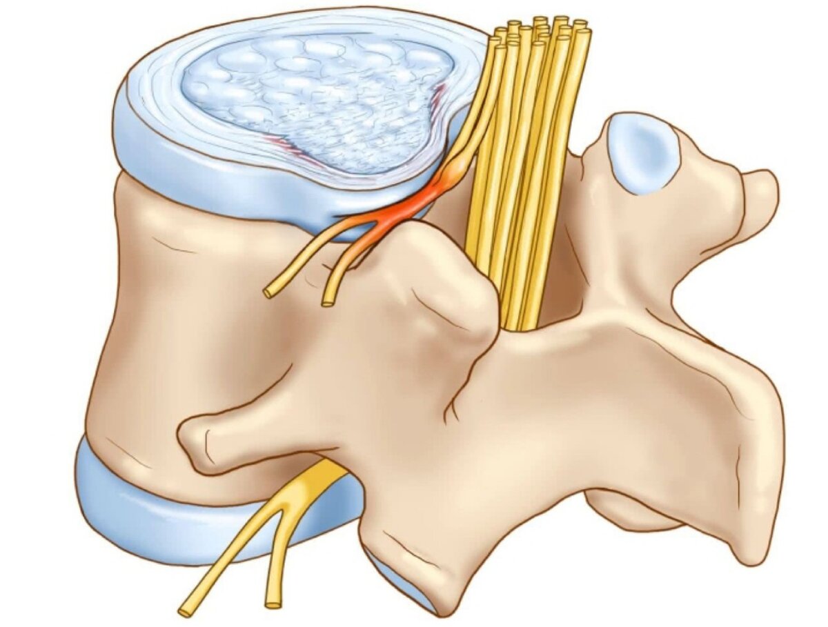 Грыжа воздействует на нервный корешок позвоночника, это и вызывает болевые ощущения