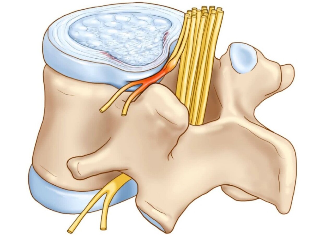 Лечение межпозвоночной грыжи в Казани