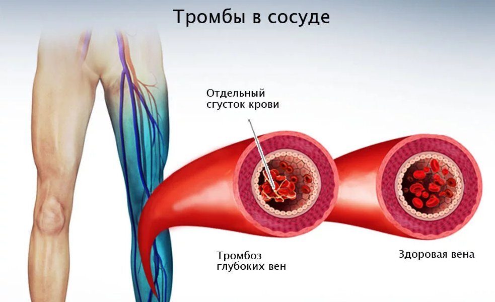 Картинка оторвался тромб