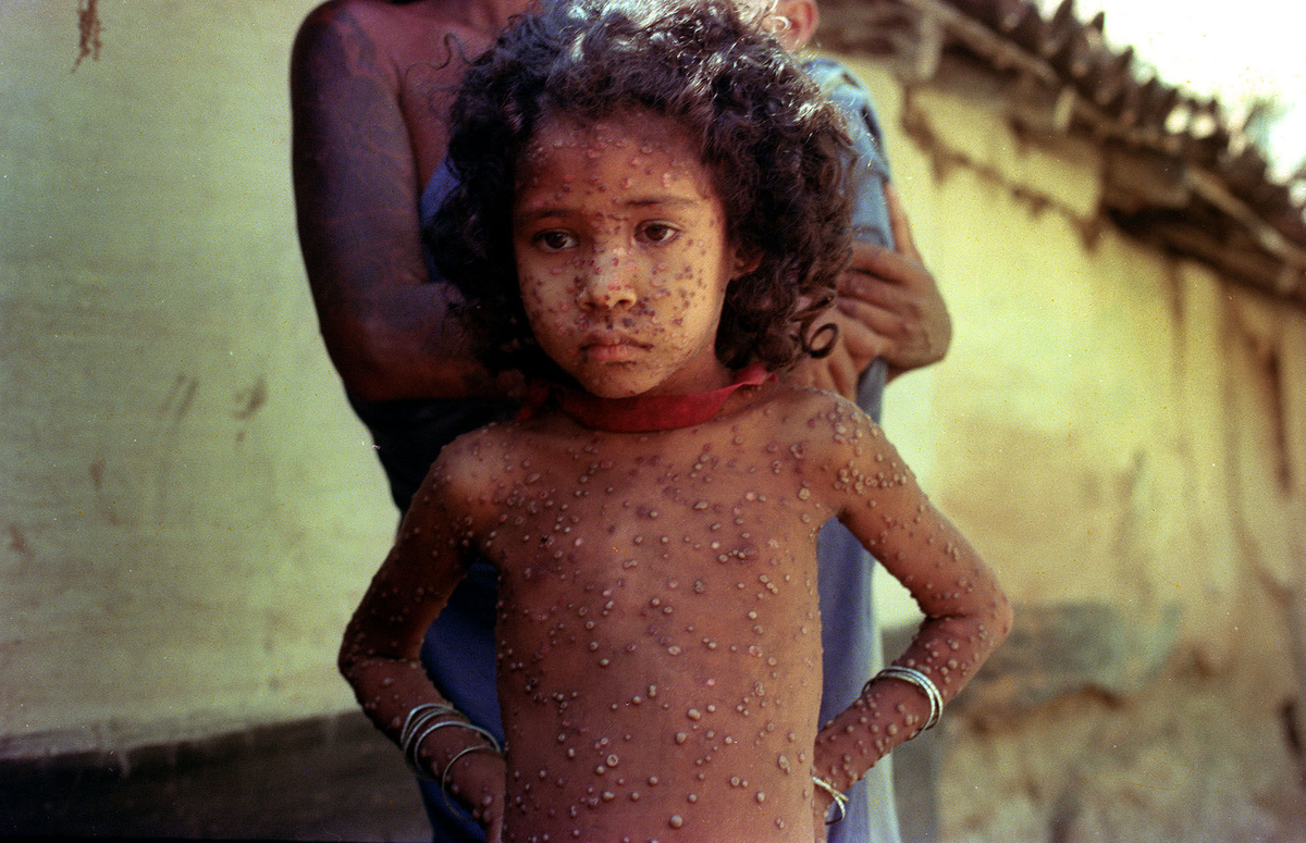 Ребенок, зараженный оспой.