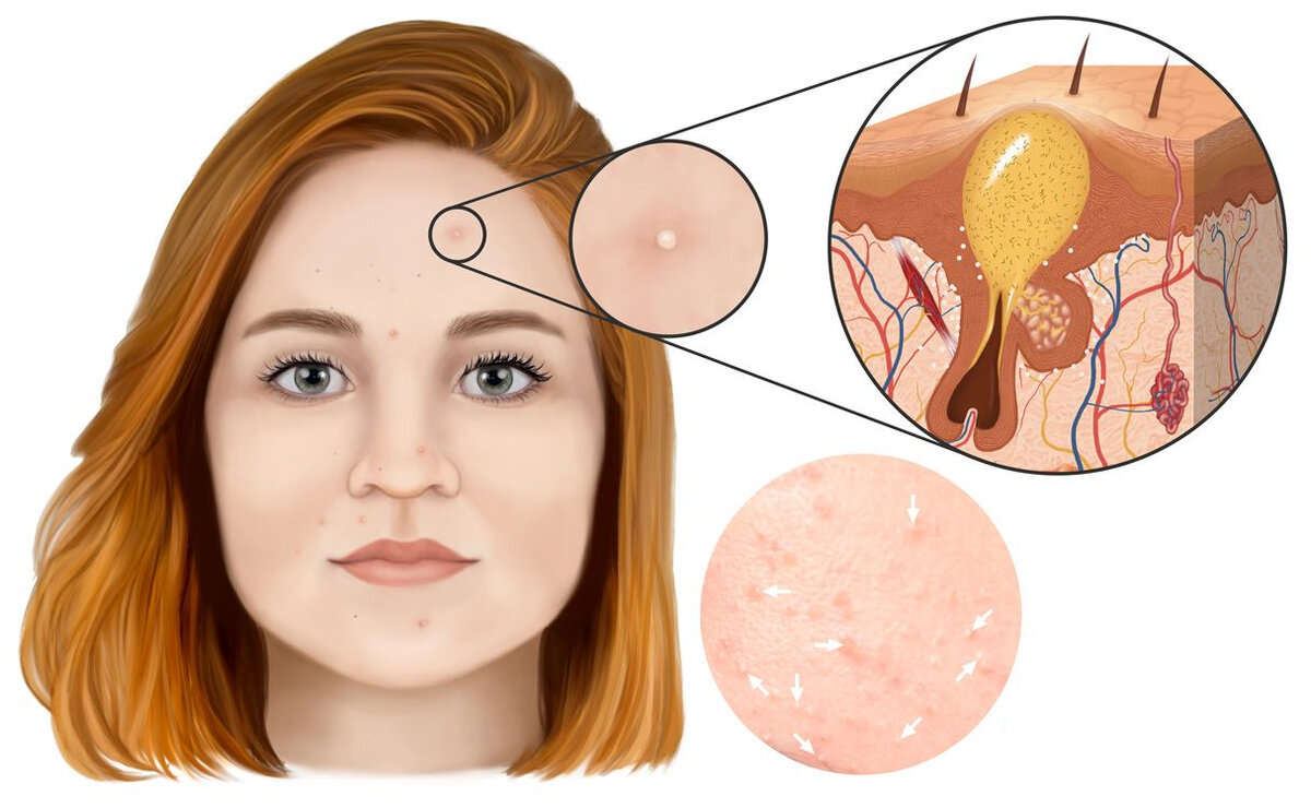 Комедоны? СТОП! Проверьте состав вашего крема! | МедПроСвет | Дзен