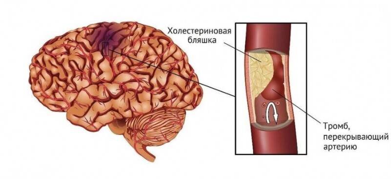 Накопленный холестерин