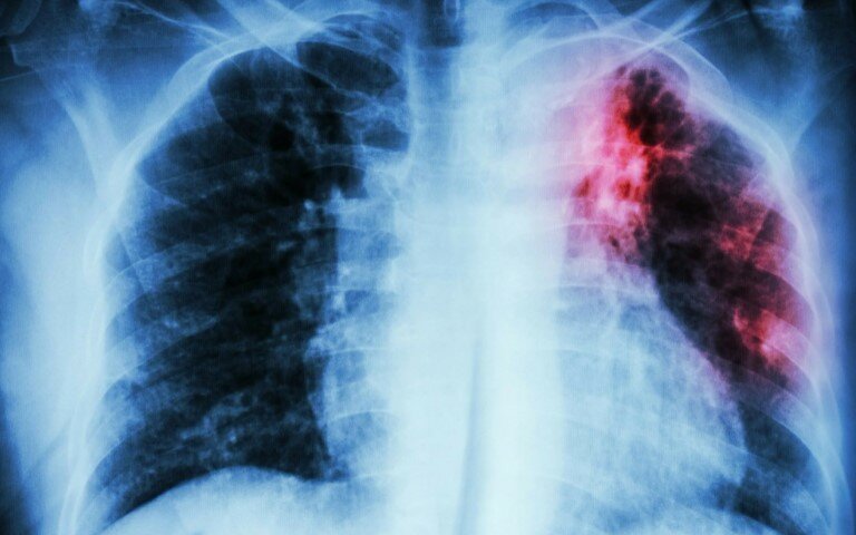 Современное лечение туберкулёза