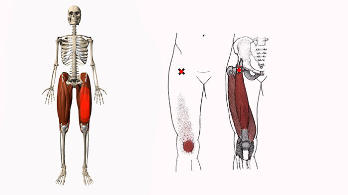 Боль в ноге в правом бедре. Триггерные точки портняжная мышца. Передняя мышца бедра болит. Боль наружная поверхность бедра. Болит внешняя поверхность бедра.