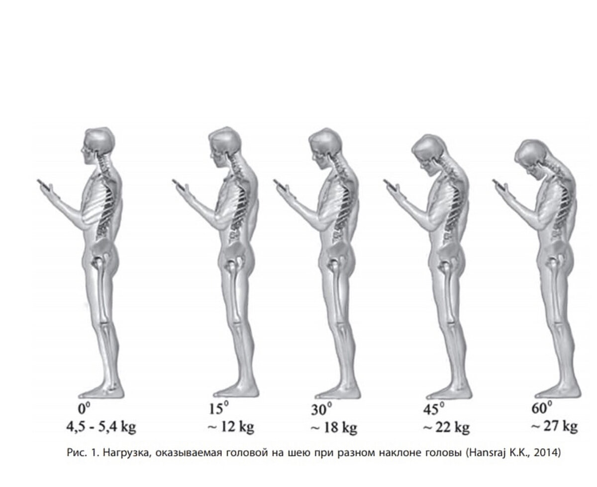 Sms шея. Нагрузка на позвоночник в зависимости от наклона головы. Нагрузка на шею при наклоне головы. Вес головы при наклоне. Нагрузка на шейный отдел.