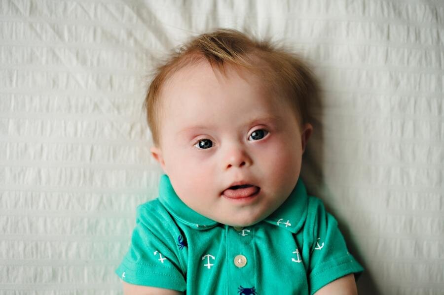 новорожденный с синдромом Дауна