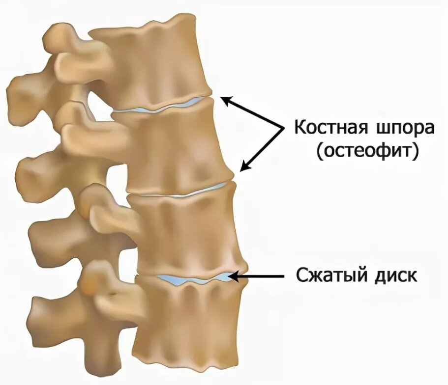 Краевые остеофиты тел позвонков что это такое фото