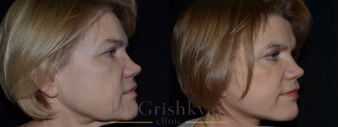 SMAS-лифтинг с укороченным рубцом фото до и после. Фото с сайта Д.Р. Гришкяна. Имеются противопоказания, требуется консультация специалиста