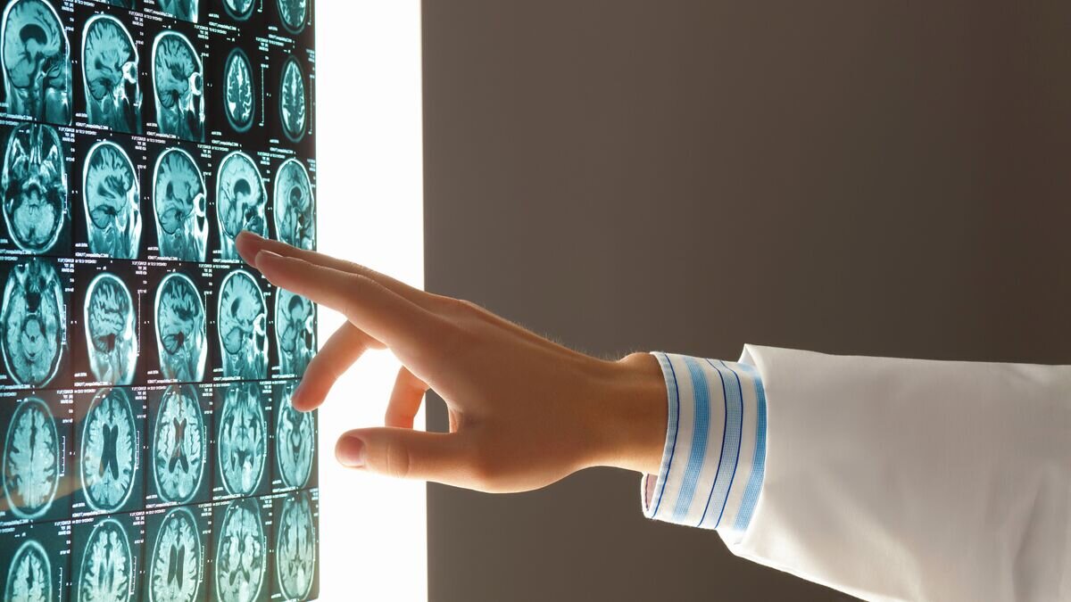    Врач изучает снимки головного мозга человека© Fotolia / Sergey Nivens