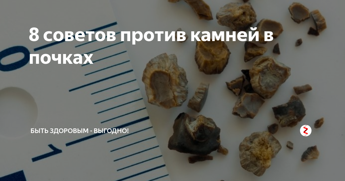 Как выглядят камни в почках
