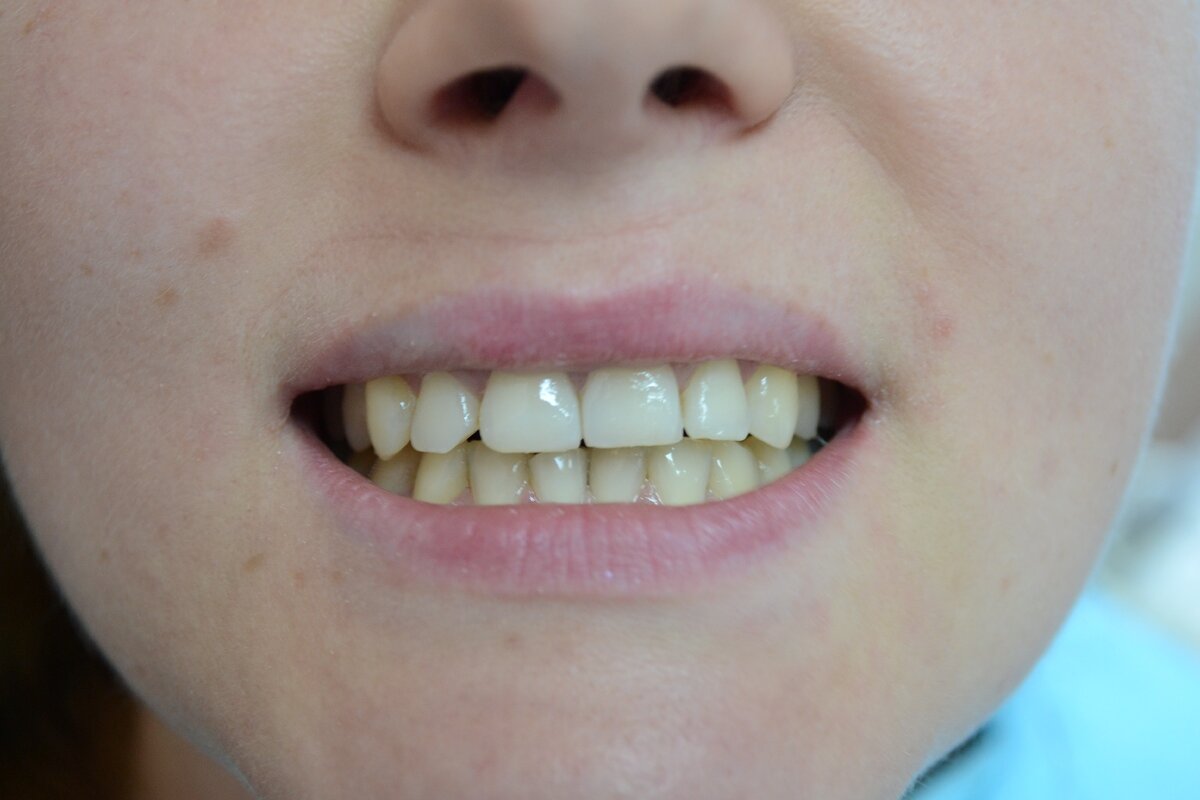 Передние зубы с зазубринами