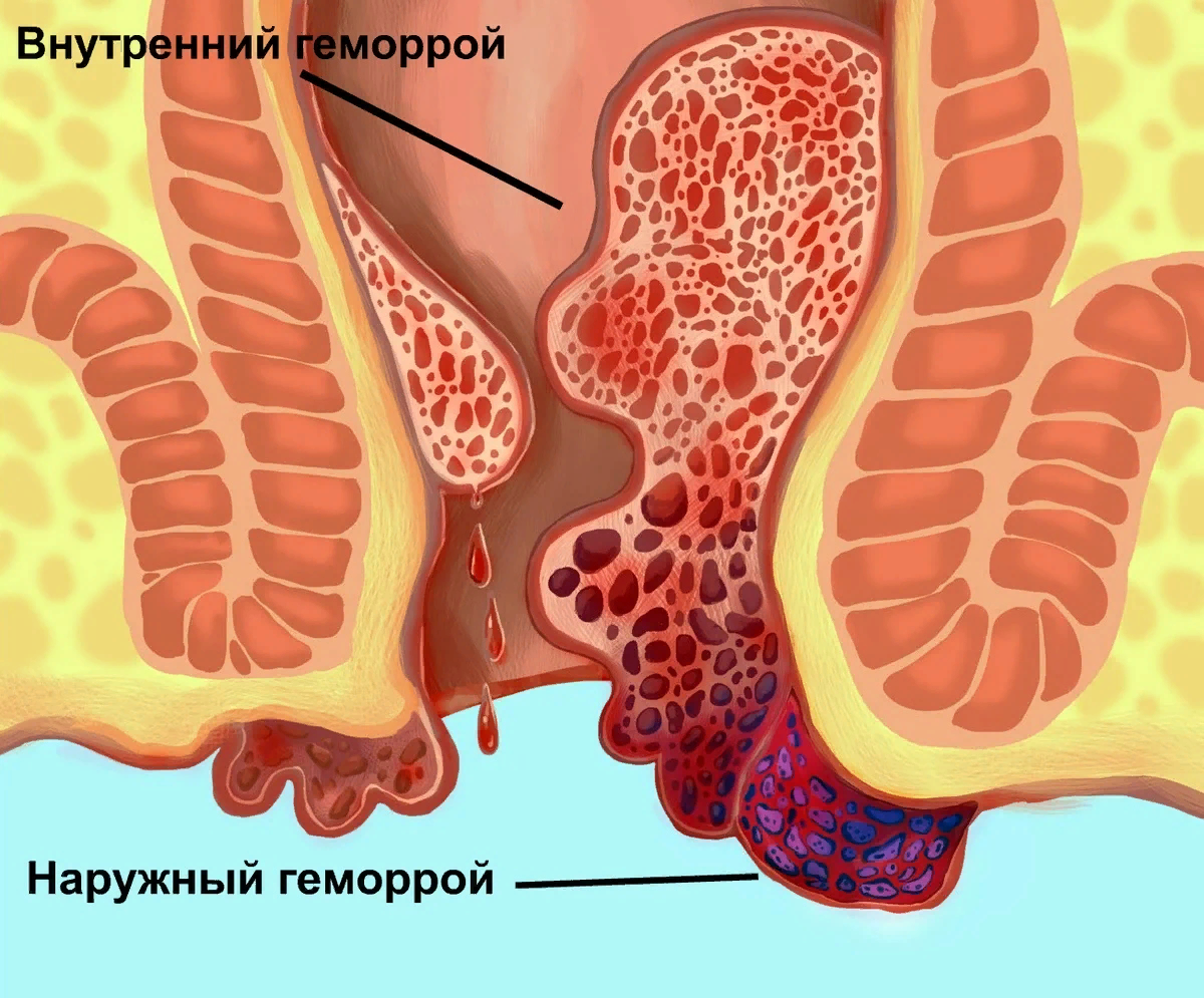 Стадии геморроя - симптомы, признаки и лечение 1, 2, 3 и 4 стадии