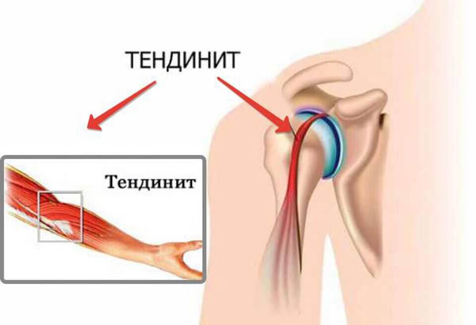 Тендинит