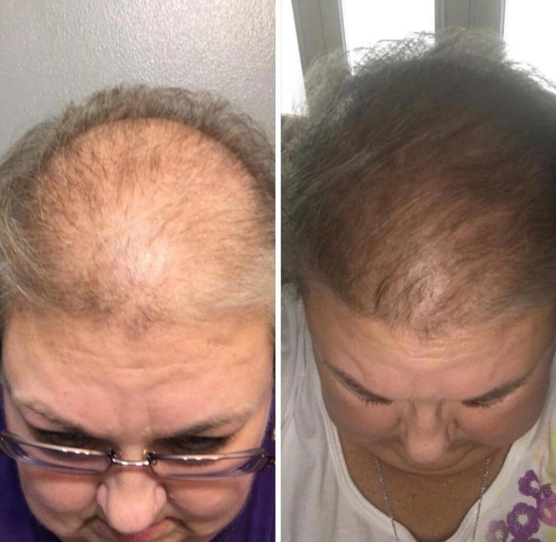 Причину выпадения волос после 40. Гиперандрогенная алопеция. Андрогенная алопеция Селенцин.