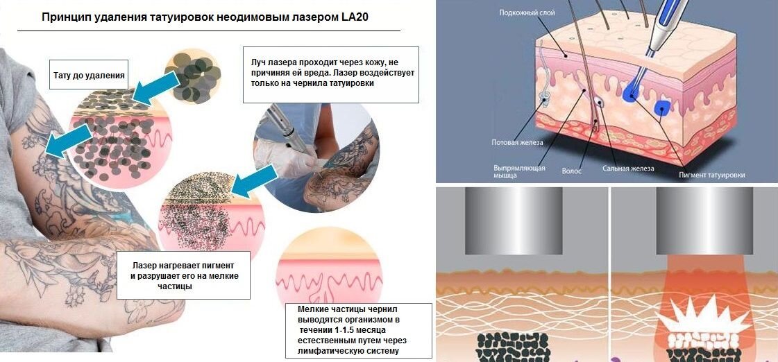 Разрушение пигментов. Процесс нанесения Татуировки схема. Лазерное удаление тату. Принцип работы лазерного удаления Татуировки. Воздействие неодимового лазера на кожу.