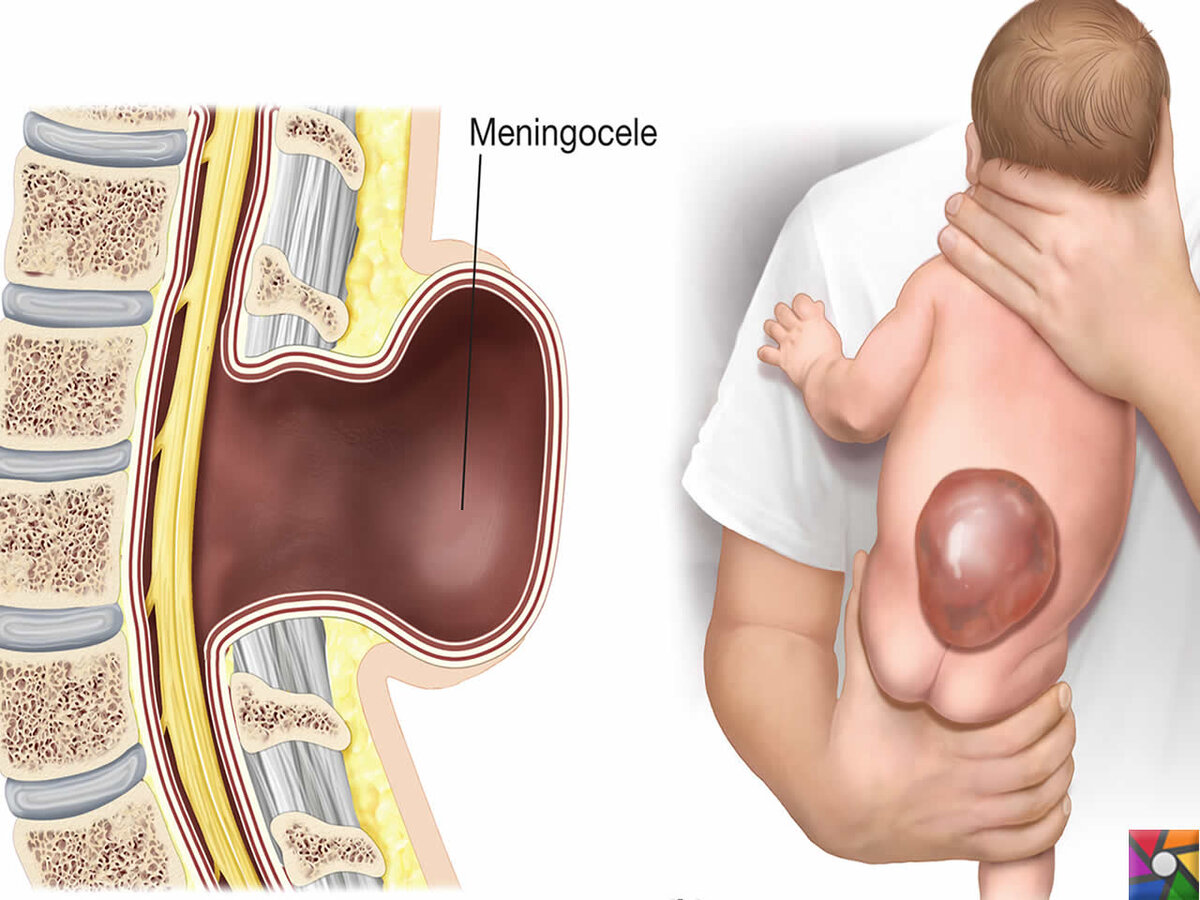 Одна из форм так называемой "spina bifida" расщепление позвоночника. Менингоцеле.