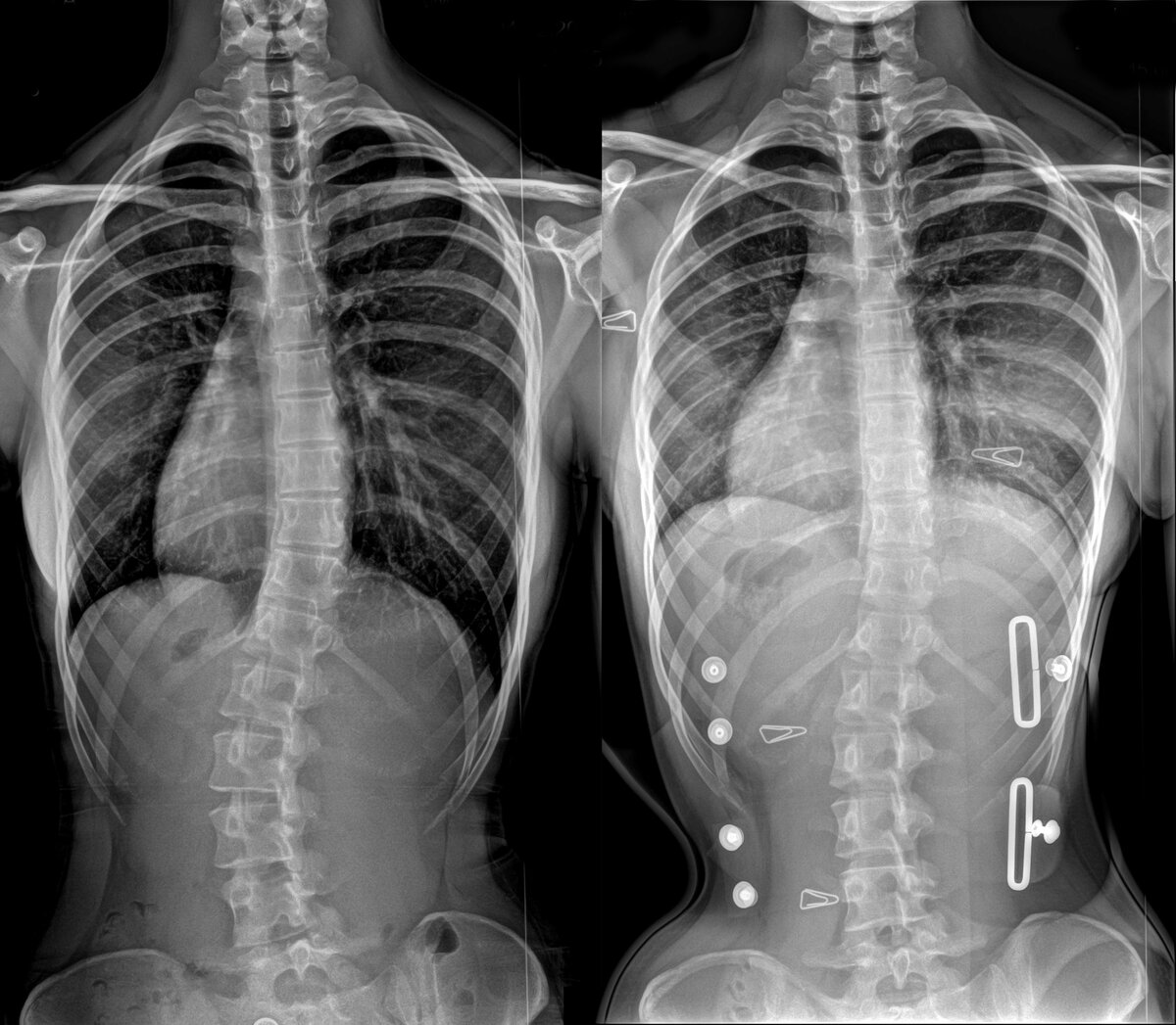 Сколиоз 2 степени. Грудной сколиоз рентген. Идиопатический сколиоз рентген. Степени сколиоза рентген.