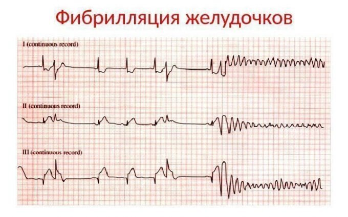 Фибрилляция желудочков на кардиограмме. Источник изображения: zabserdce.ru 