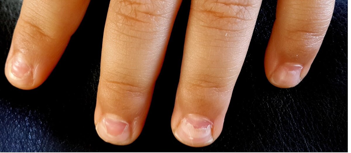 О каких диагнозах расскажут ногти ребенка?