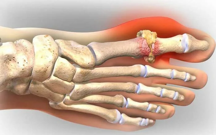 Нарост подагры