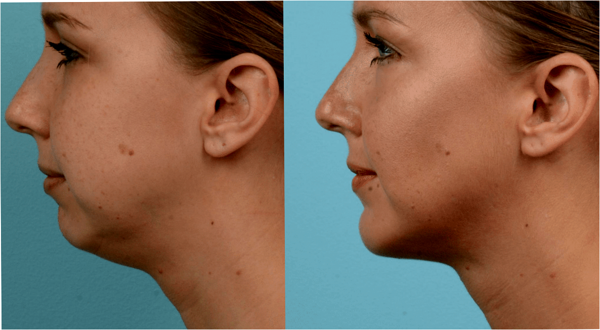 Подбородок это часть лица. Части лица. Подбородок это часть лица. Профиль джоли углый нижний челюсти подбородка. Формы подбородка женщин.