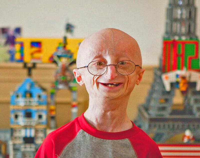 Ребенок с прогерией