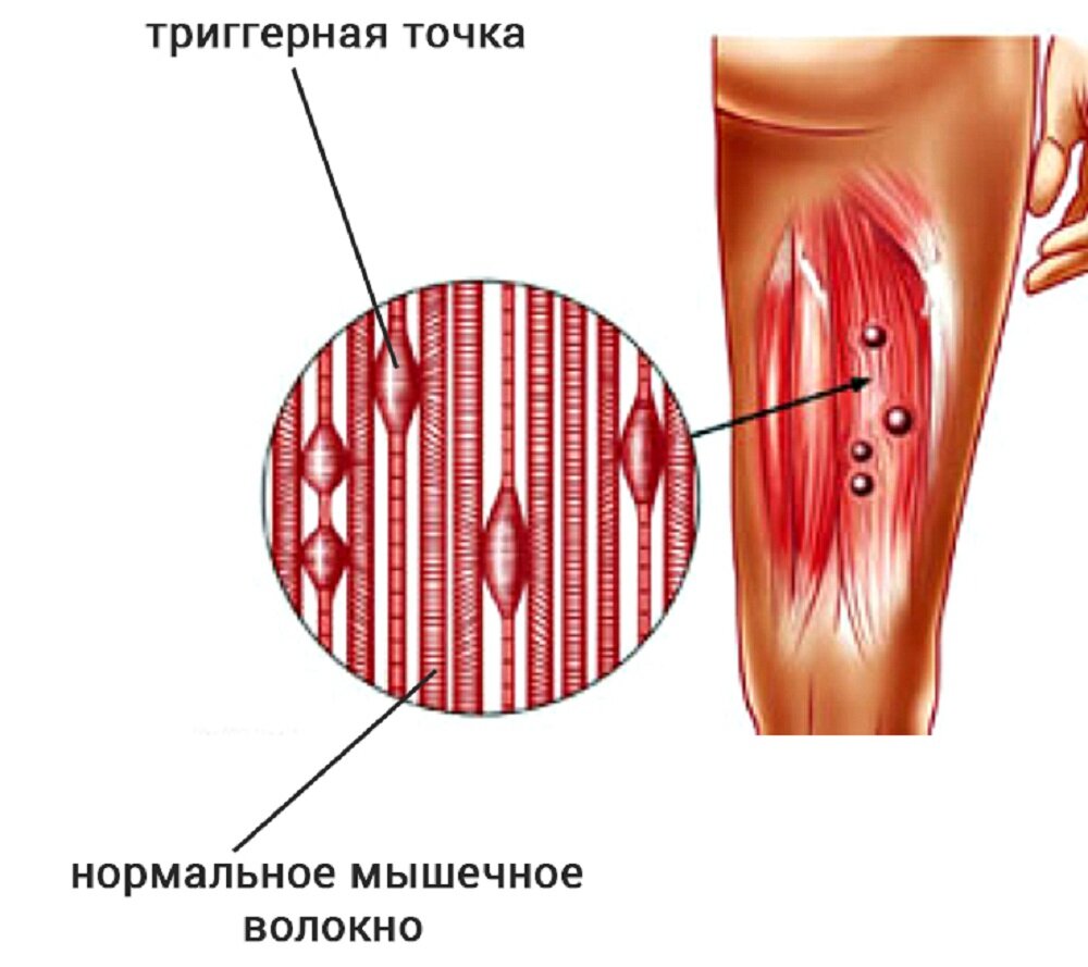 Подостная мышца триггерные точки