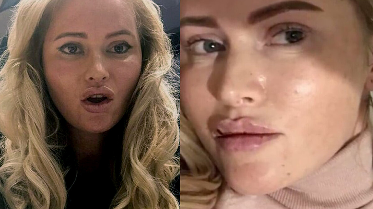 После укола красоты.