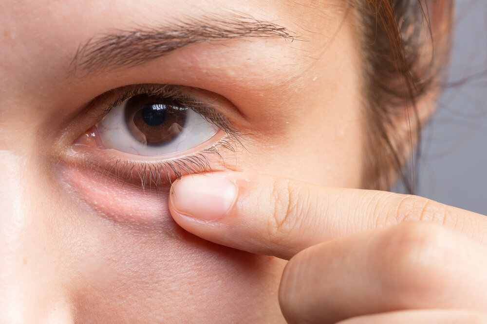 Что такое жировики и от чего они появляются? 