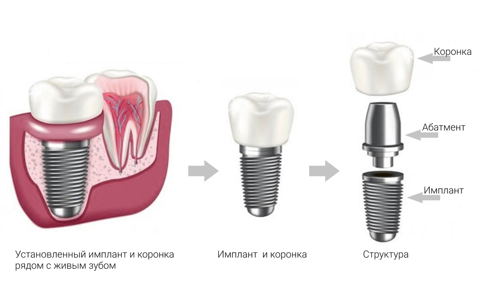 Чем отличаются зубные. Имплант абатмент коронка. Абатмент на зубной имплант. Имплант абатмент коронка Neodent. Имплант трансфер абатмент коронка.