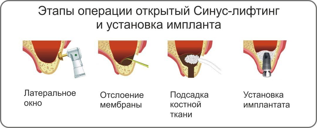 Другое название синус-лифтинга – субантральная аугментация. Суть операции в том, что приподнимается дно синусита. По этой причине такие манипуляции проводятся только на верхней челюсти.