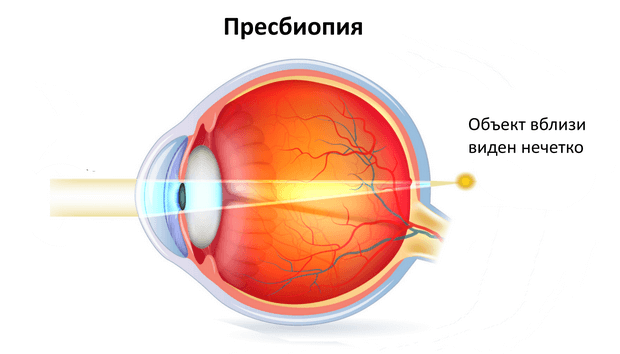 Пресбиопия глаза что это такое у взрослых. Пресбиопия глаз. Пресбиопия хрусталик. Диагноз пресбиопия. Пресбиопия симптомы.