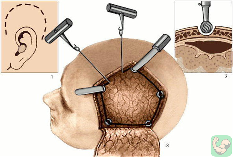 Трепанация черепа. Картинка для примера.