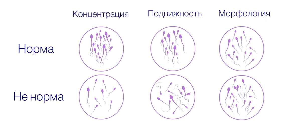 Качество сперматозоидов определяется концентрацией, подвижностью и морфологией
