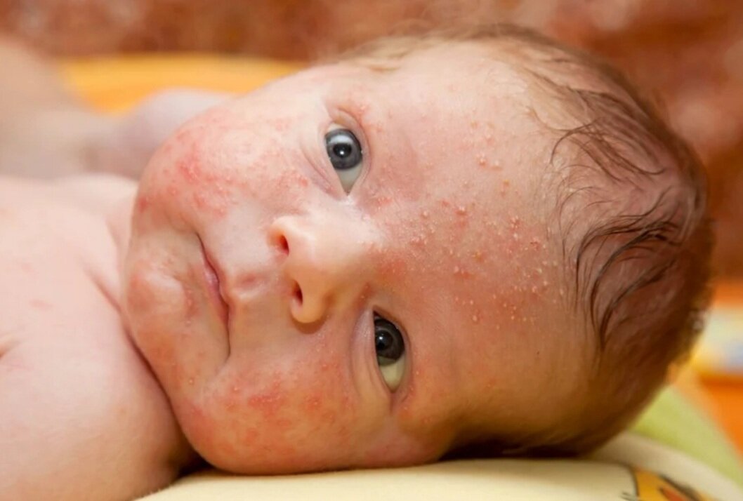 Акне новорожденных