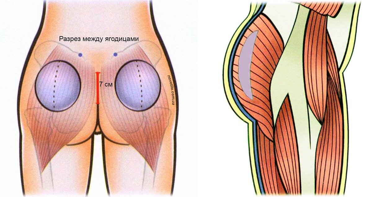 До и после ягодицы Импланты в ягодицы: фото попы до и после