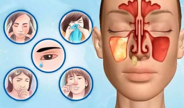 ОДИН ИЗ САМЫХ НАДЕЖНЫХ МЕТОДОВ БОРЬБЫ С НАСМОРКОМ  И ДАЖЕ ГАЙМОРИТОМ-ЭТО ПРОМЫВАНИЕ НОСА. Подсоленный раствор помогает бережно удалить скопившуюся слизь, уменьшить отек, а также снизить количество выделяемой жидкости.