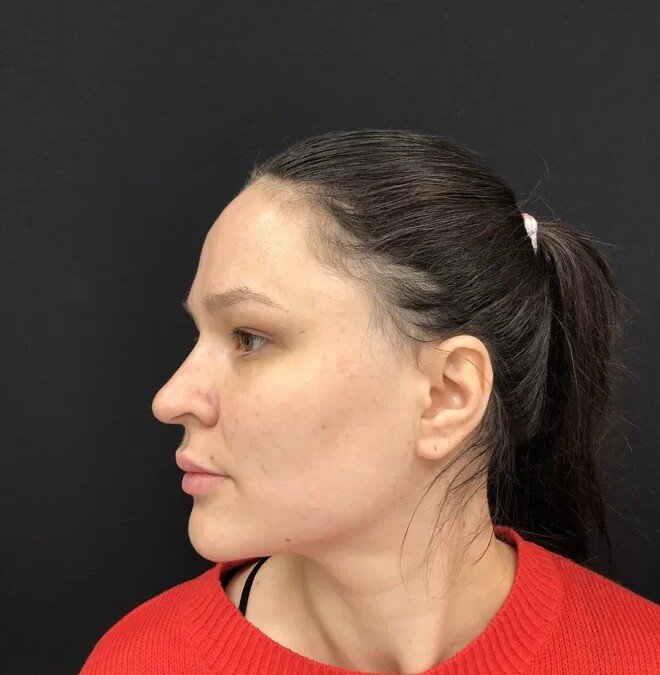 Пациентка до ринопластики.