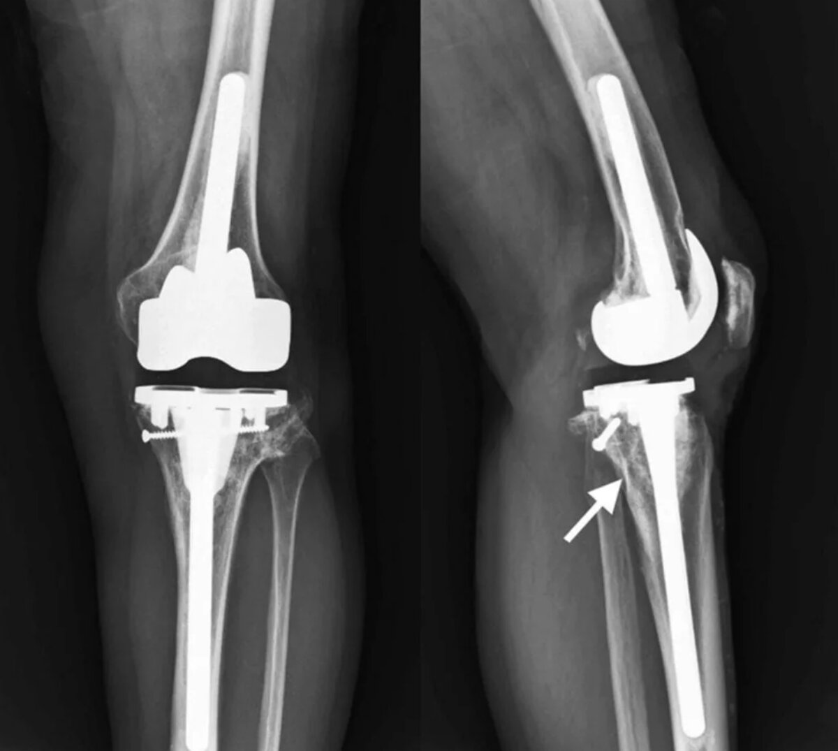 Эндопротезирование связок коленного сустава. Коленный эндопротез DEPUY. Эндопротез большеберцовой кости. Тотальное эндопротезирование коленного сустава DEPUY. Титановый эндопротез коленного сустава.