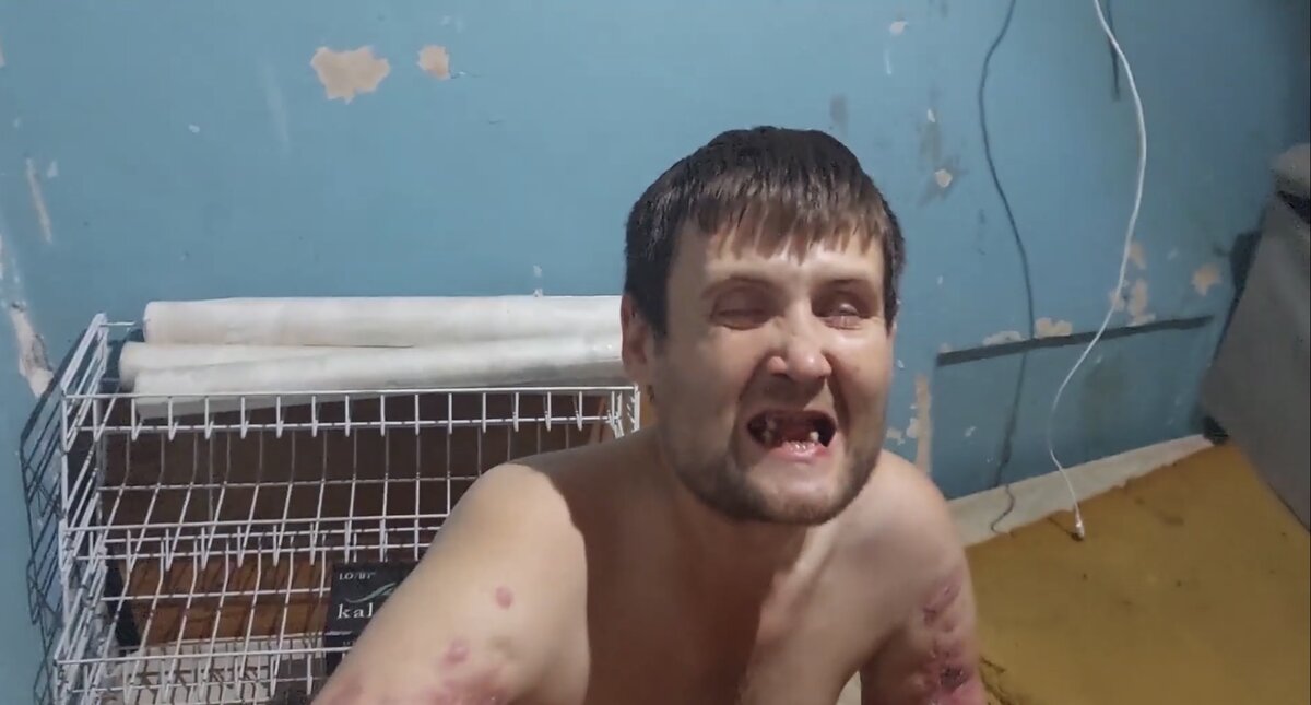 Фото гниющего метадонового наркомана взято из нашего телеграмм канала.