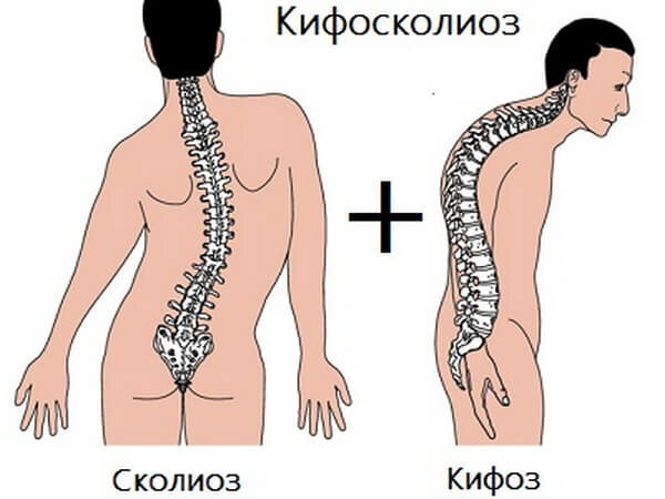 Кифосколиоз: симптомы, лечение и профилактика