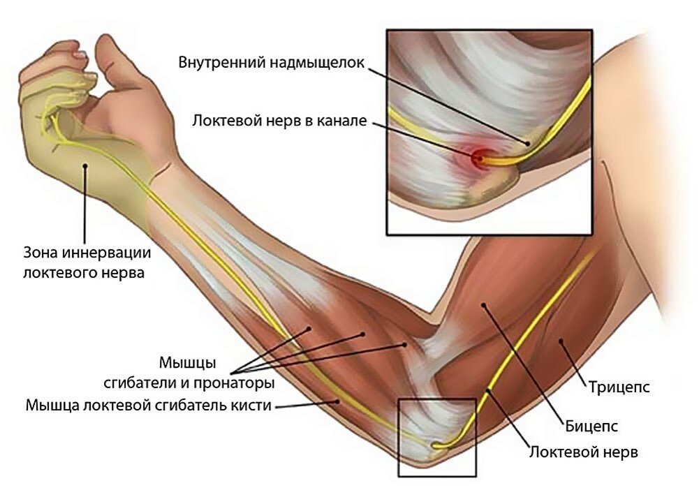 Лечение защемления локтевого нерваь?